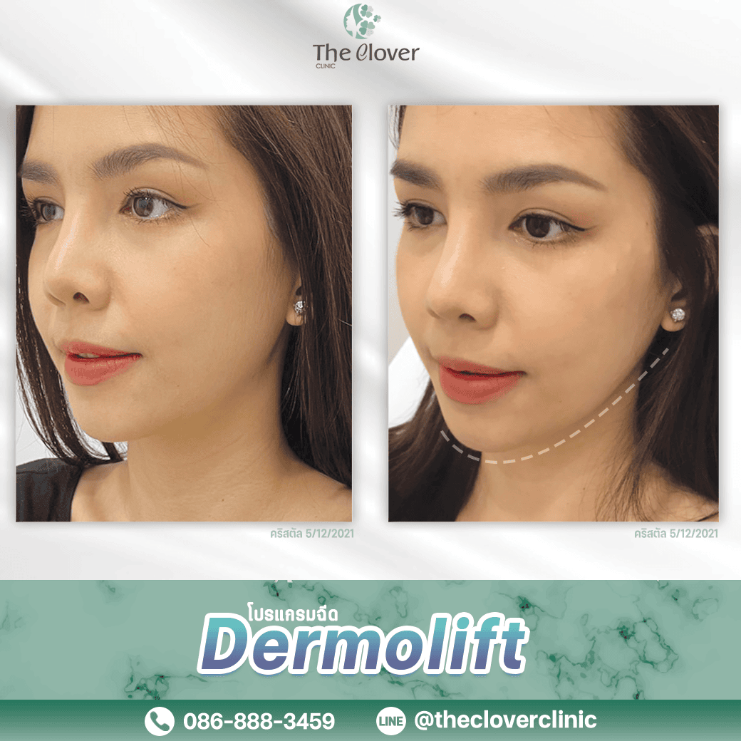 Dermolift