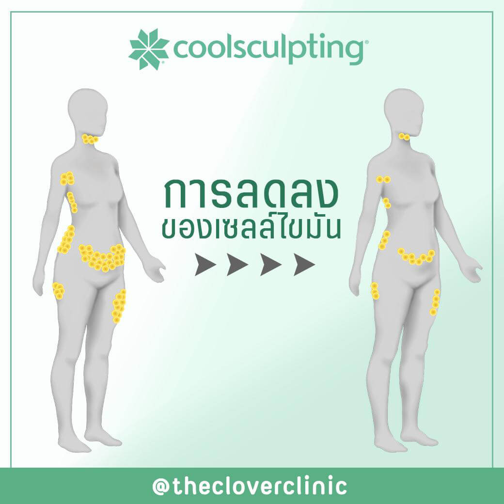 CoolSculpting