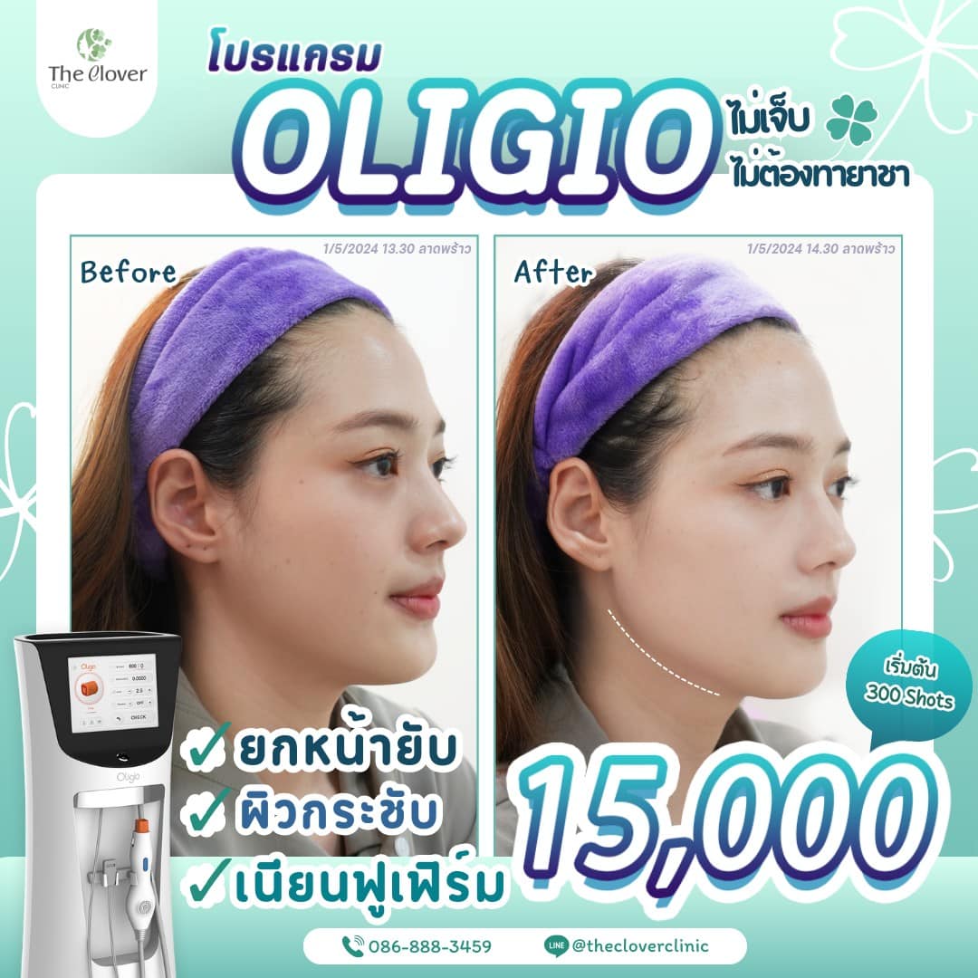 รีวิว oligio