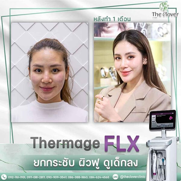 thermage flx