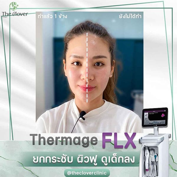 Thermage เทอร์มาจ