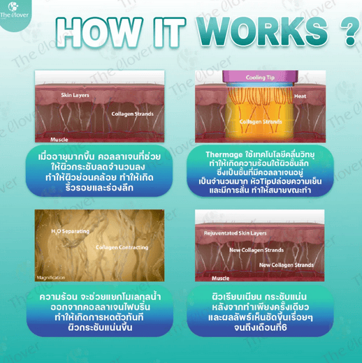 Thermage, how it works 