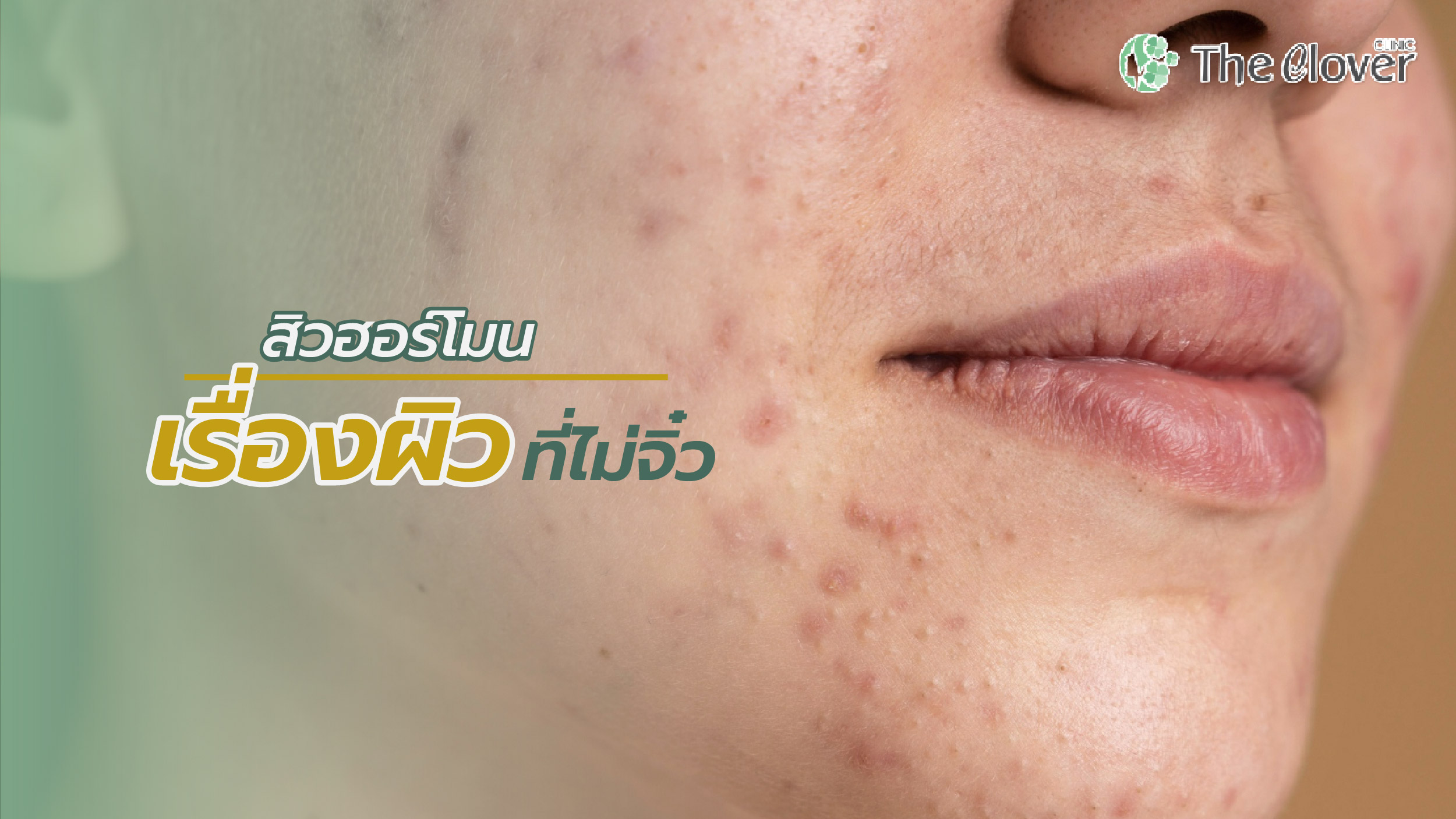 สิวฮอร์โมน