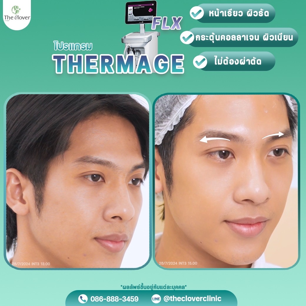thermage หนังตาตก