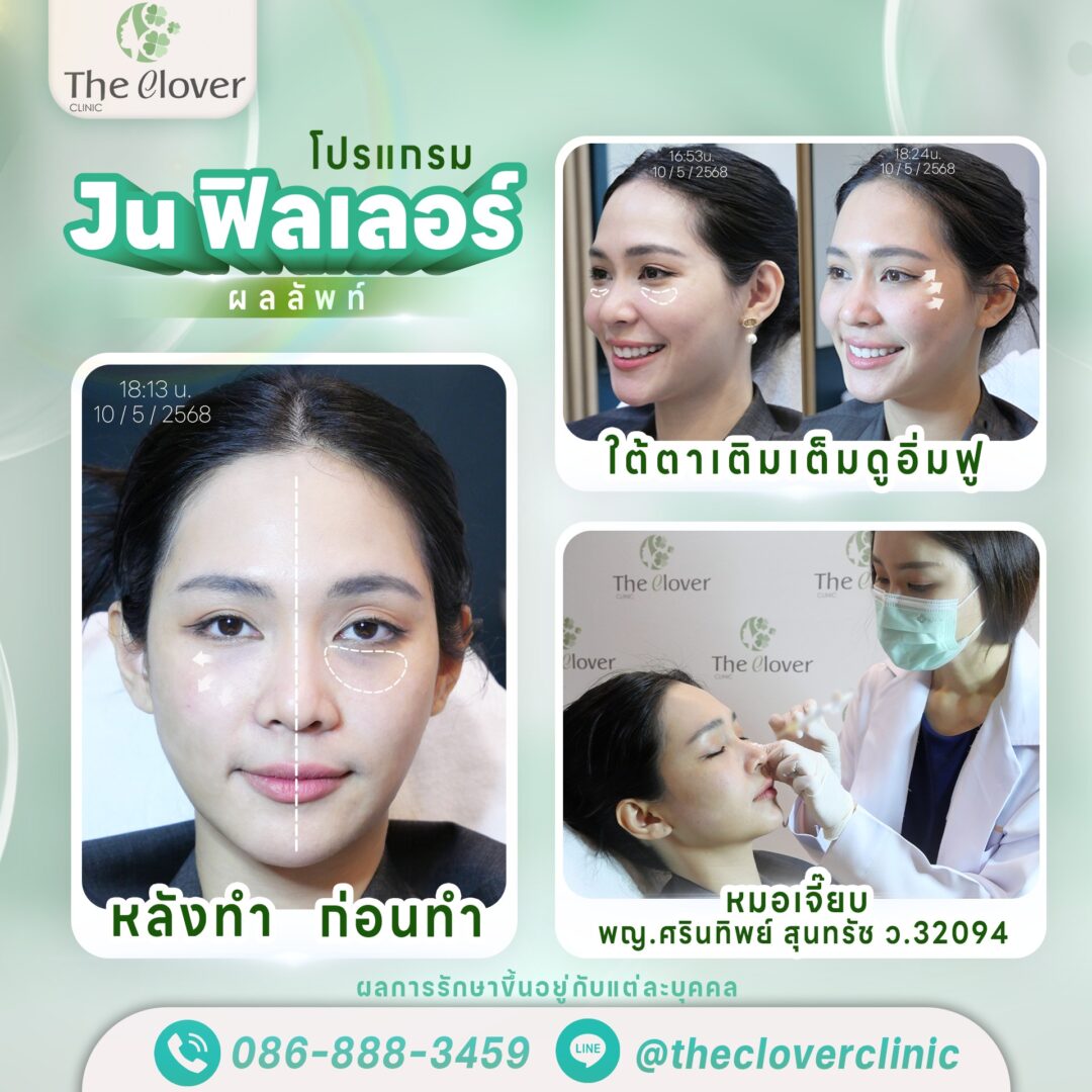 โปรแกรม JU ฟิลเลอร์