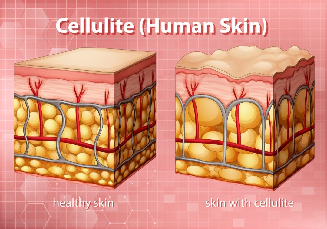 cellulite - The Clover Clinic cellulite