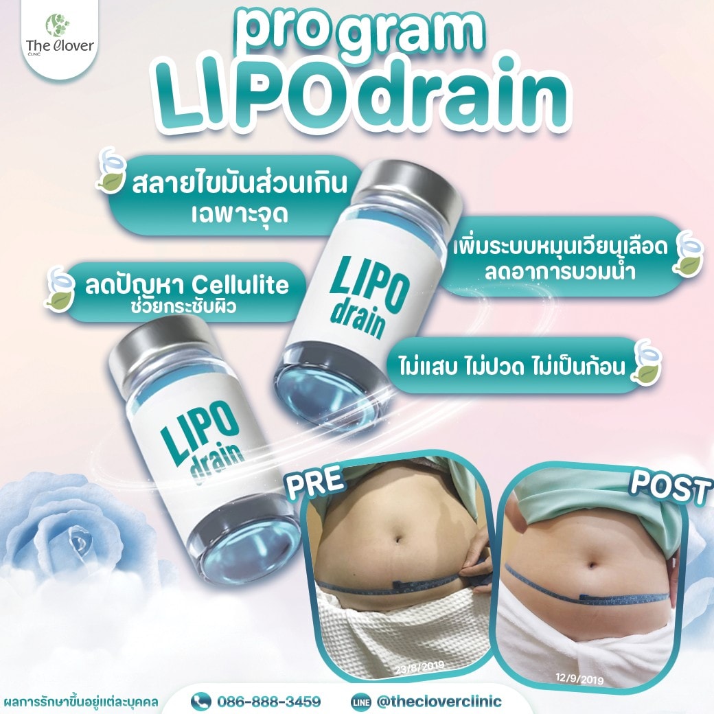 lipo drain - The Clover Clinic lipo drain
