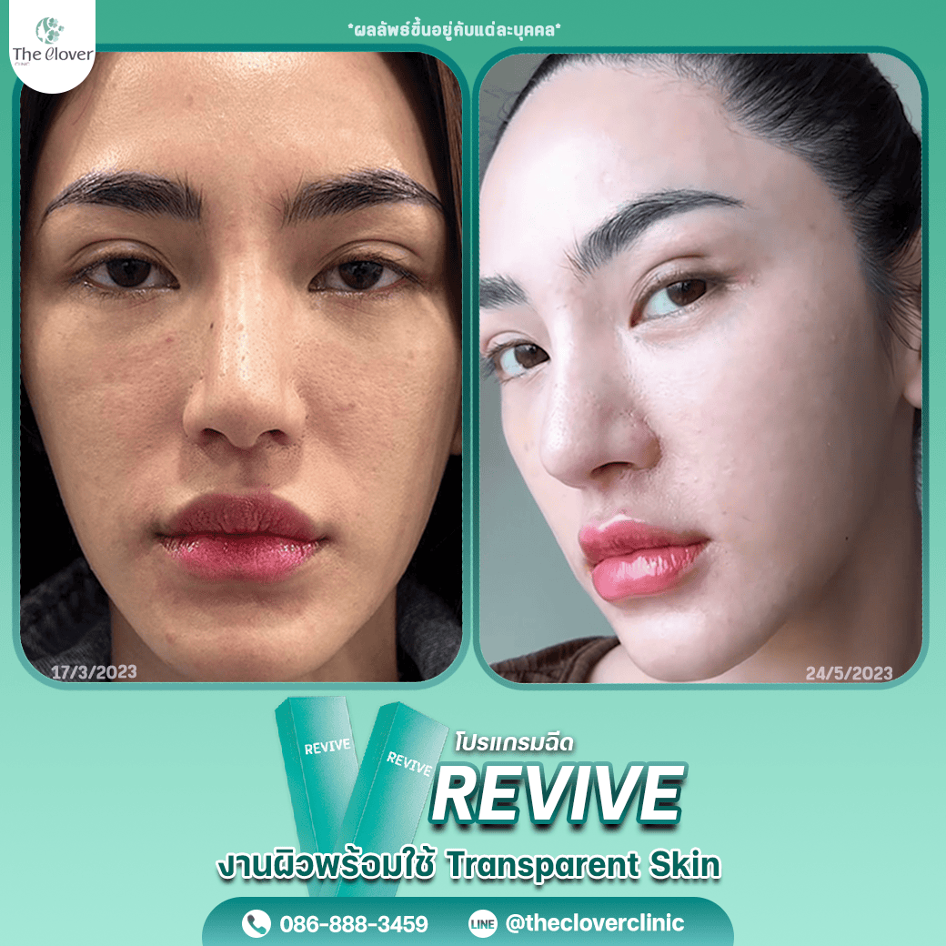 revive11 - The Clover Clinic