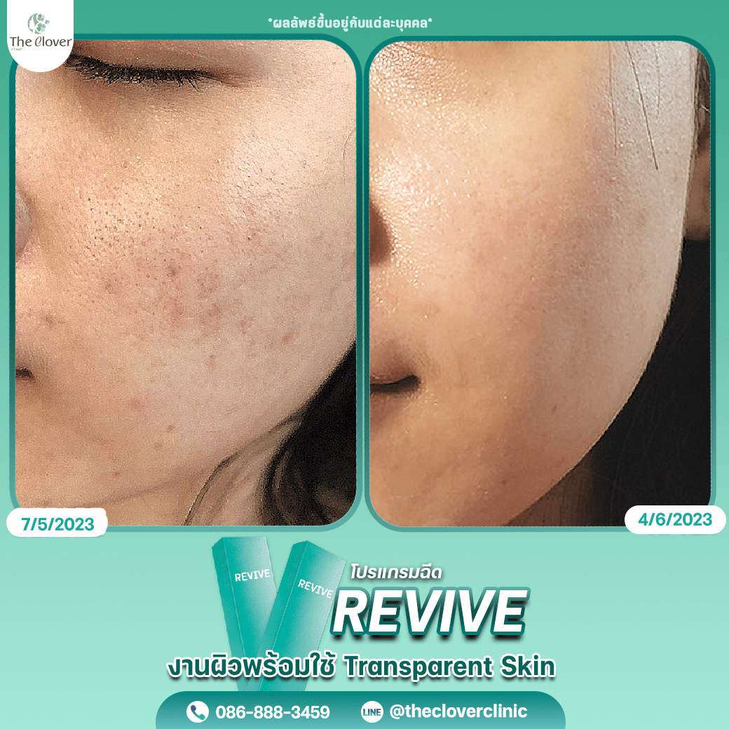 revive8 - The Clover Clinic