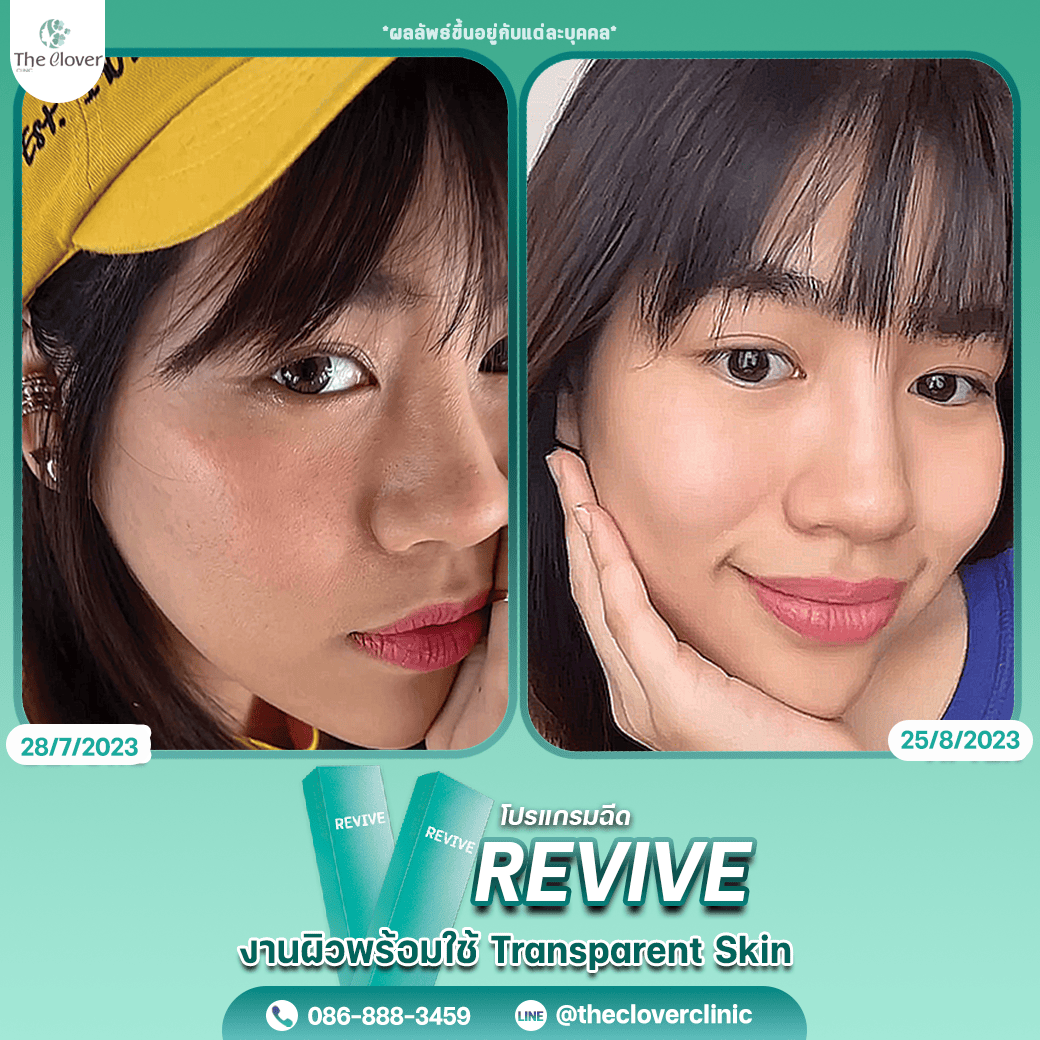 revive9 - The Clover Clinic