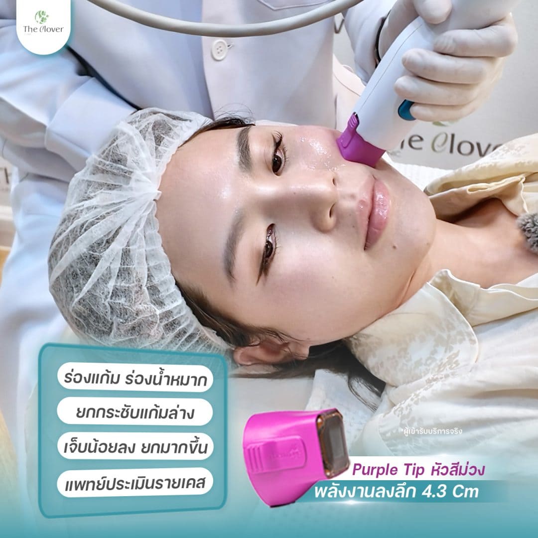 thermage flx 1 - The Clover Clinic thermage flx หัวสีม่วง