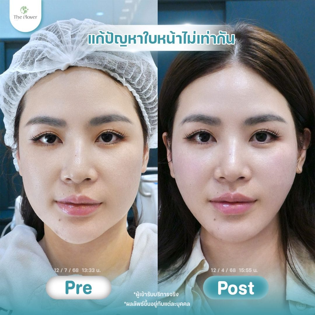 thermage flx 3 - The Clover Clinic แก้ปัญหาใบหน้าไม่เท่ากัน