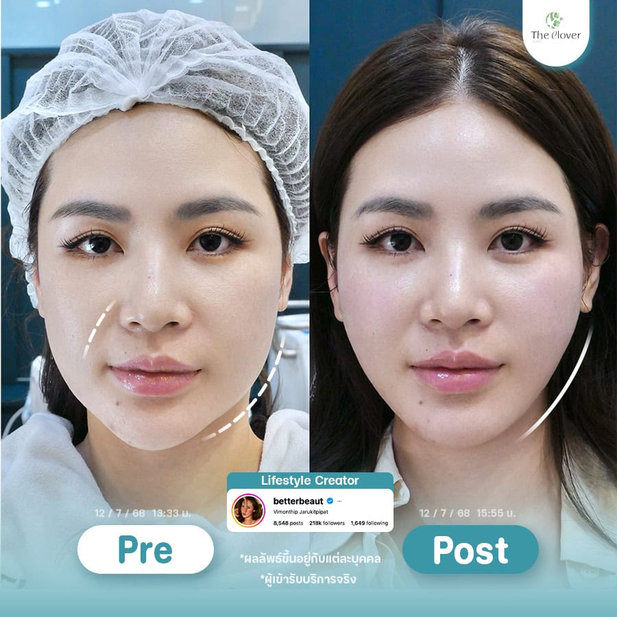 thermage flx 6 - The Clover Clinic โปรแกรมกระชับท้องแขน