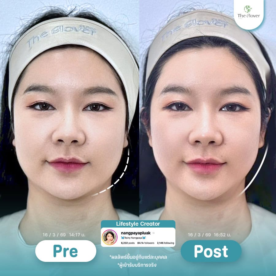 thermage flx 7 - The Clover Clinic โปรแกรมกระชับท้องแขน
