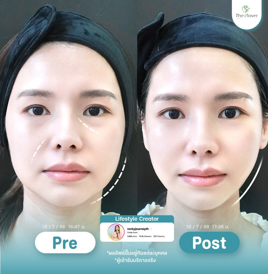 thermage flx5 - The Clover Clinic บอกลาเซลลูไลท์