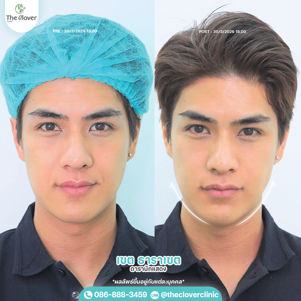 ket-prime-5 - The Clover Clinic เขต ธาราเขต ulthera prime